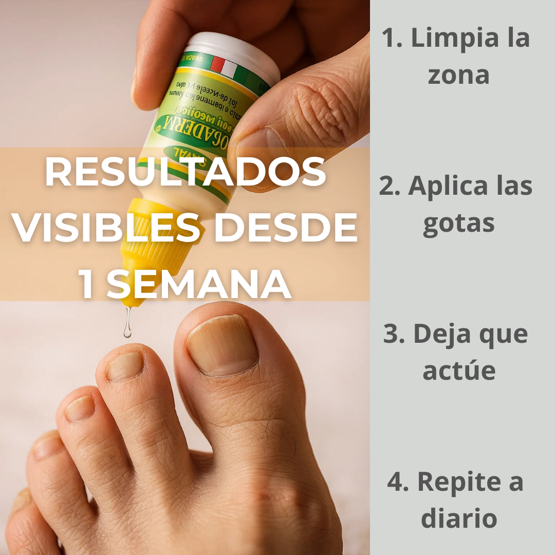 TRATAMIENTO EFECTIVO ANTIHONGOS – Uñas limpias y saludables en 4 semanas
