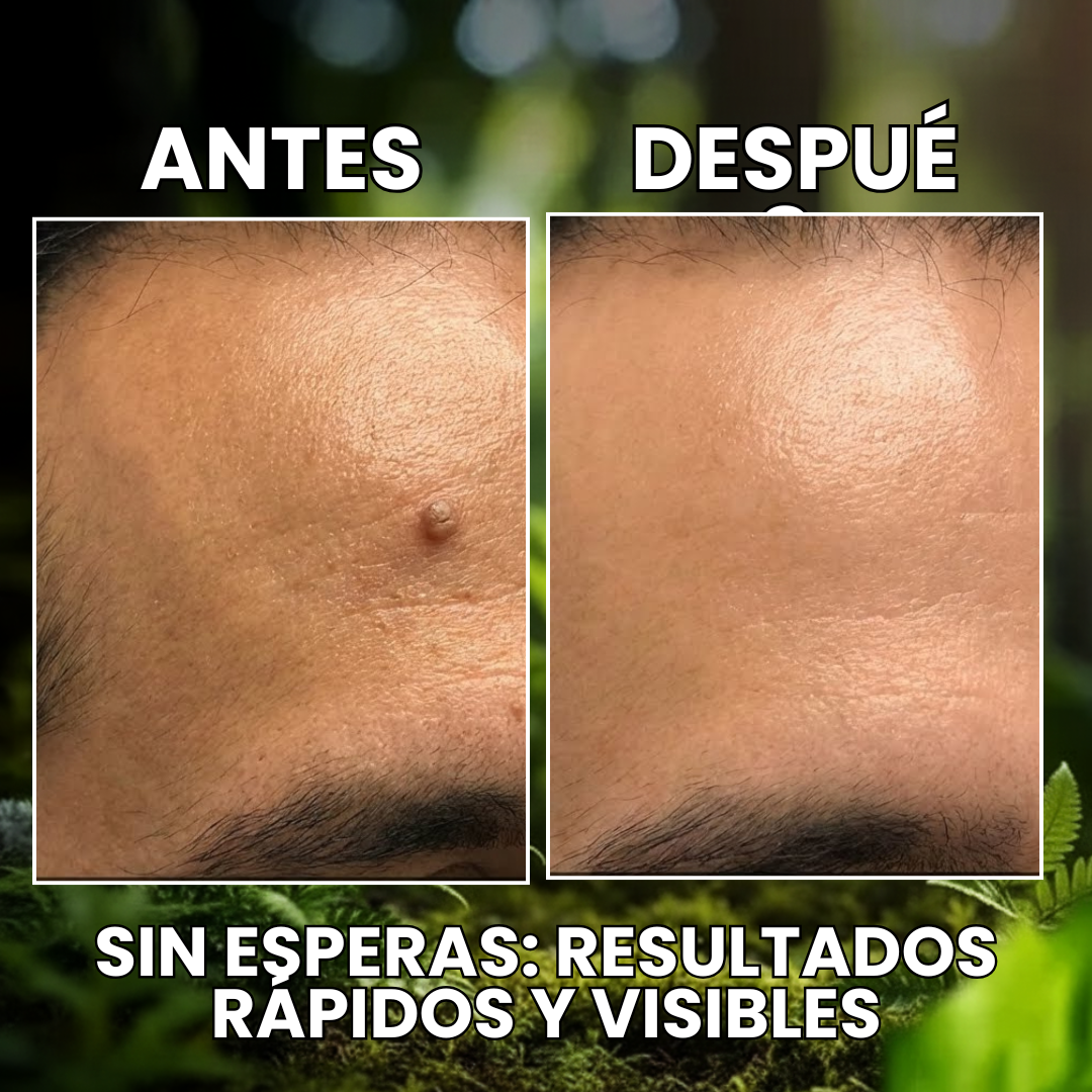 TagOff – Eliminador Cutáneo Natural – Adiós Verrugas Desde Casa