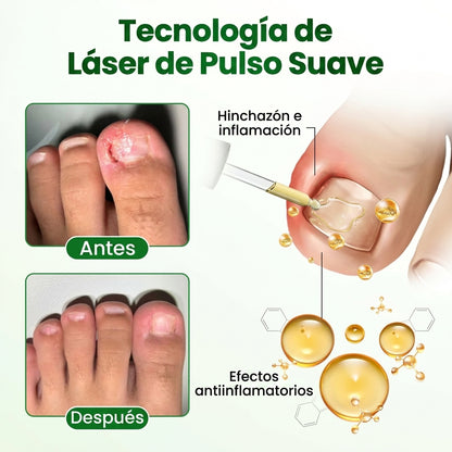 Aceite Antifúngico - Restauración de Uñas - Ayuda a recuperar la salud de tus pies